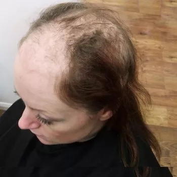 female client shows bare pacthes caused by trichotillomania