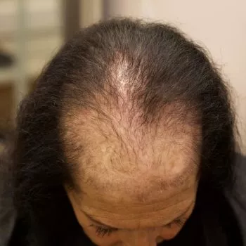 Female Client With Genetic Thinning Hair Loss