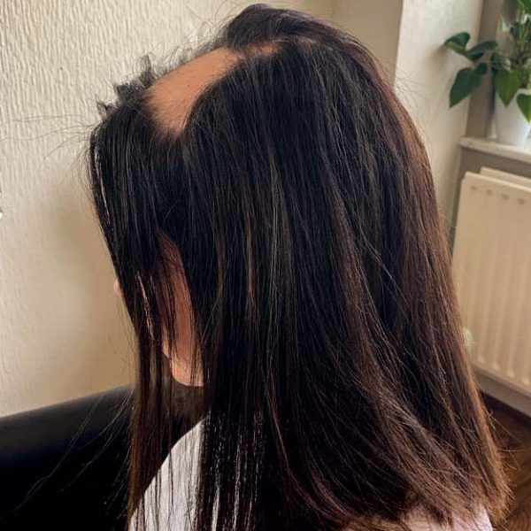 KATIE_BEFORE 3 Female with bald patches caused by Alopecia before hair loss solution fitted