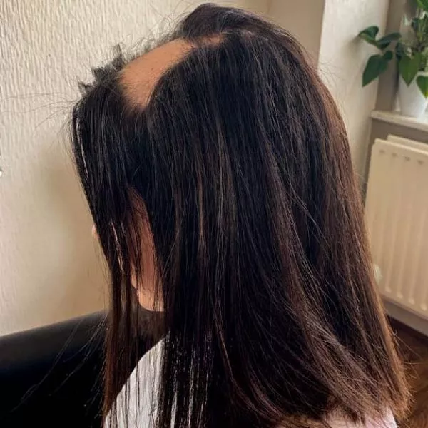 KATIE_BEFORE 3 Female with bald patches caused by Alopecia before hair loss solution fitted