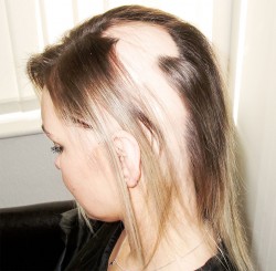 Joanna, client with Alopecia before Enhancer system was fitted