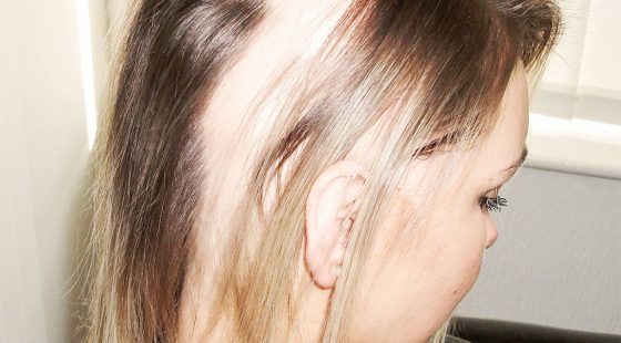 Female with large bald patches from Alopecia Areata before Enhancer System