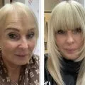 Female client with thinning hair before and after the fitting of the Enhancer System