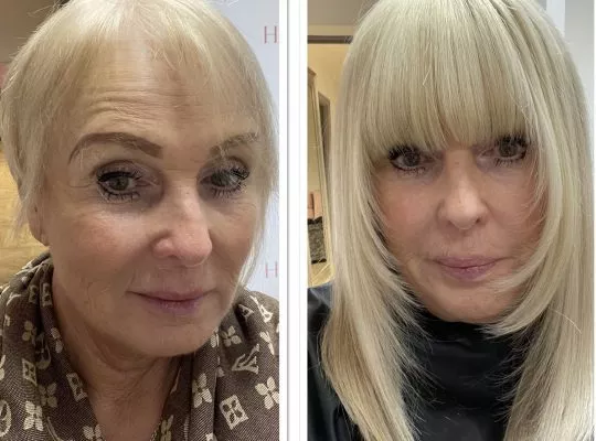 Female client with thinning hair before and after the fitting of the Enhancer System